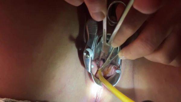 Tenaculum Grasping Cervix For Catheter 7 Min - hclips.com on nochargetube.com